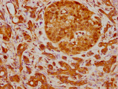 IHC image of RAC07794 diluted at 1:210 and staining in paraffin-embedded human pancreatic cancer performed on a Leica BondTM system. After dewaxing and hydration, antigen retrieval was mediated by high pressure in a citrate buffer (pH 6.0). Section was blocked with 10% normal goat serum 30min at RT. Then primary antibody (1% BSA) was incubated at 4? overnight. The primary is detected by a biotinylated secondary antibody and visualized using an HRP conjugated SP system.