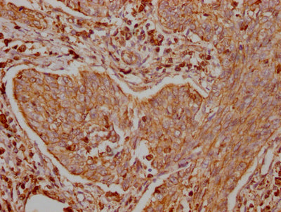 IHC image of RAC07796 diluted at 1:100 and staining in paraffin-embedded human cervical cancer performed on a Leica BondTM system. After dewaxing and hydration, antigen retrieval was mediated by high pressure in a citrate buffer (pH 6.0). Section was blocked with 10% normal goat serum 30min at RT. Then primary antibody (1% BSA) was incubated at 4? overnight. The primary is detected by a Goat anti-rabbit IgG polymer labeled by HRP and visualized using 0.05% DAB.