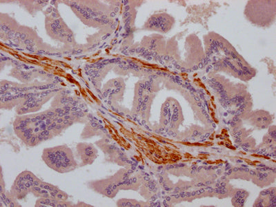 IHC image of RAC07798 diluted at 1:100 and staining in paraffin-embedded human prostate cancer performed on a Leica BondTM system. After dewaxing and hydration, antigen retrieval was mediated by high pressure in a citrate buffer (pH 6.0). Section was blocked with 10% normal goat serum 30min at RT. Then primary antibody (1% BSA) was incubated at 4? overnight. The primary is detected by a Goat anti-rabbit IgG polymer labeled by HRP and visualized using 0.05% DAB.