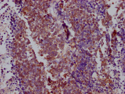 IHC image of RAC07801 diluted at 1:100 and staining in paraffin-embedded human lung cancer performed on a Leica BondTM system. After dewaxing and hydration, antigen retrieval was mediated by high pressure in a citrate buffer (pH 6.0). Section was blocked with 10% normal goat serum 30min at RT. Then primary antibody (1% BSA) was incubated at 4? overnight. The primary is detected by a Goat anti-rabbit IgG polymer labeled by HRP and visualized using 0.05% DAB.