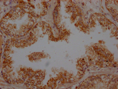 IHC image of RAC07807 diluted at 1:100 and staining in paraffin-embedded human prostate cancer performed on a Leica BondTM system. After dewaxing and hydration, antigen retrieval was mediated by high pressure in a citrate buffer (pH 6.0). Section was blocked with 10% normal goat serum 30min at RT. Then primary antibody (1% BSA) was incubated at 4? overnight. The primary is detected by a Goat anti-rabbit IgG polymer labeled by HRP and visualized using 0.05% DAB.