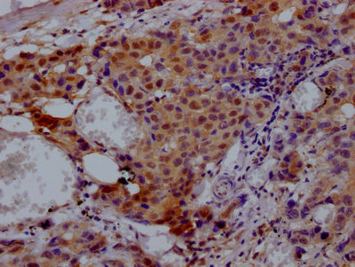 IHC image of RAC07812 diluted at 1:100 and staining in paraffin-embedded human breast cancer performed on a Leica BondTM system. After dewaxing and hydration, antigen retrieval was mediated by high pressure in a citrate buffer (pH 6.0). Section was blocked with 10% normal goat serum 30min at RT. Then primary antibody (1% BSA) was incubated at 4? overnight. The primary is detected by a Goat anti-rabbit IgG polymer labeled by HRP and visualized using 0.05% DAB.