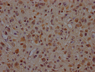 IHC image of RAC07812 diluted at 1:100 and staining in paraffin-embedded human glioma cancer performed on a Leica BondTM system. After dewaxing and hydration, antigen retrieval was mediated by high pressure in a citrate buffer (pH 6.0). Section was blocked with 10% normal goat serum 30min at RT. Then primary antibody (1% BSA) was incubated at 4? overnight. The primary is detected by a Goat anti-rabbit IgG polymer labeled by HRP and visualized using 0.05% DAB.