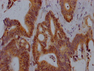 IHC image of RAC07813 diluted at 1:100 and staining in paraffin-embedded human colon cancer performed on a Leica BondTM system. After dewaxing and hydration, antigen retrieval was mediated by high pressure in a citrate buffer (pH 6.0). Section was blocked with 10% normal goat serum 30min at RT. Then primary antibody (1% BSA) was incubated at 4? overnight. The primary is detected by a Goat anti-rabbit IgG polymer labeled by HRP and visualized using 0.05% DAB.