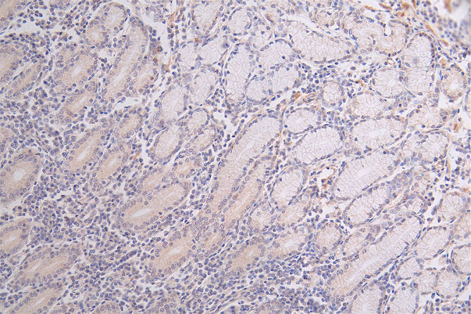 IHC image diluted at 1:50 and staining in paraffin-embedded human breast cancer performed on a Leica BondTM system. After dewaxing and hydration, antigen retrieval was mediated by high pressure in a citrate buffer (pH 6.0). Section was blocked with 10% normal goat serum 30min at RT. Then primary antibody (1% BSA) was incubated at 4Â°C overnight. The primary is detected by a Goat anti-rabbit polymer IgG labeled by HRP and visualized using 0.60% DAB.