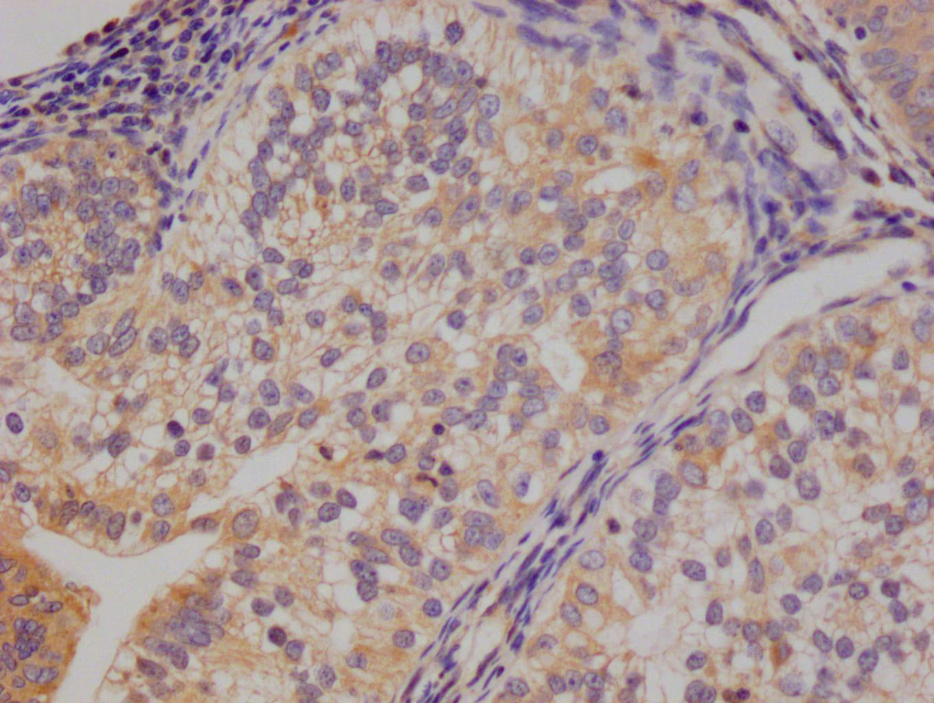 IHC image of RAC07819 diluted at 1:100 and staining in paraffin-embedded human endometrial cancer performed on a Leica BondTM system. After dewaxing and hydration, antigen retrieval was mediated by high pressure in a citrate buffer (pH 6.0). Section was blocked with 10% normal goat serum 30min at RT. Then primary antibody (1% BSA) was incubated at 4Â°C overnight. The primary is detected by a Goat anti-rabbit polymer IgG labeled by HRP and visualized using 0.05% DAB.