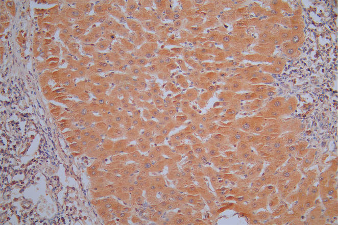 IHC image of RAC07825 diluted at 1:30 and staining in paraffin-embedded human liver cancer performed on a Leica BondTM system. After dewaxing and hydration, antigen retrieval was mediated by high pressure in a citrate buffer (pH 6.0). Section was blocked with 10% normal goat serum 30min at RT. Then primary antibody (1% BSA) was incubated at 4Â°C overnight. The primary is detected by a Goat anti-Mouse IgG labeled by HRP and visualized using 0.05% DAB.