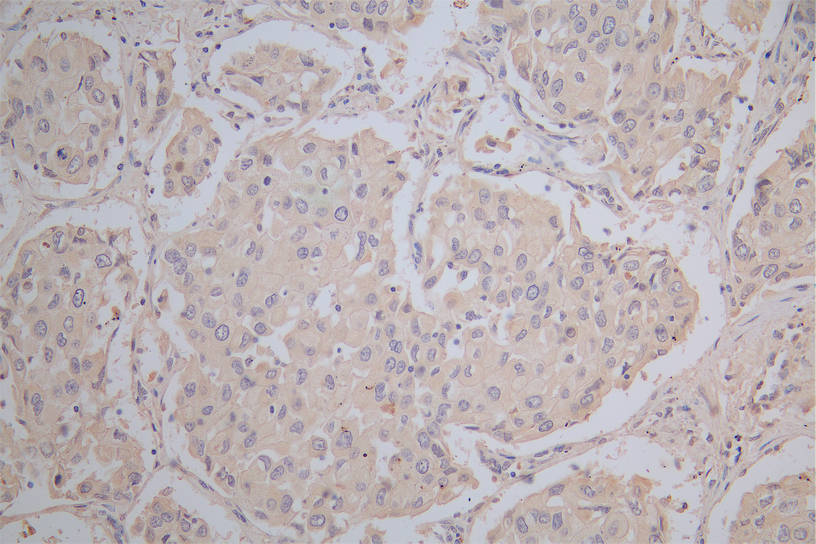 IHC image of RAC07837 diluted at 1:100 and staining in paraffin-embedded human lung cancer performed on a Leica BondTM system. After dewaxing and hydration, antigen retrieval was mediated by high pressure in a citrate buffer (pH 6.0). Section was blocked with 10% normal goat serum 30min at RT. Then primary antibody (1% BSA) was incubated at 4Â°C overnight. The primary is detected by a Goat anti-Mouse IgG labeled by HRP and visualized using 0.05% DAB.