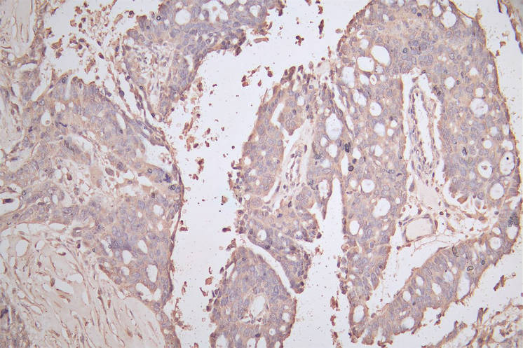 IHC image of RAC07846 diluted at 1:200 and staining in paraffin-embedded human endometrial cancer performed on a Leica BondTM system. After dewaxing and hydration, antigen retrieval was mediated by high pressure in a citrate buffer (pH 6.0). Section was blocked with 10% normal goat serum 30min at RT. Then primary antibody (1% BSA) was incubated at 4Â°C overnight. The primary is detected by a Goat anti-Mouse IgG labeled by HRP and visualized using 0.05% DAB.