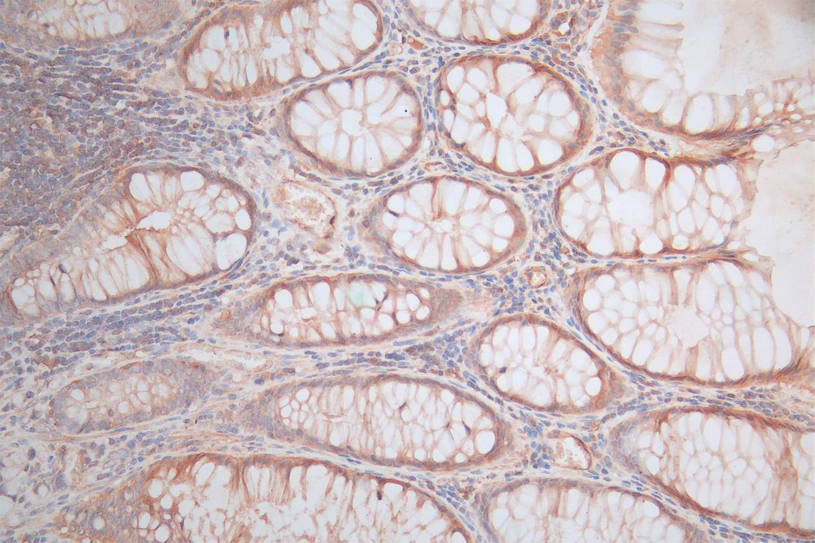 IHC image of RAC07857 diluted at 1:100 and staining in paraffin-embedded human rectal cancer performed on a Leica BondTM system. After dewaxing and hydration, antigen retrieval was mediated by high pressure in a citrate buffer (pH 6.0). Section was blocked with 10% normal goat serum 30min at RT. Then primary antibody (1% BSA) was incubated at 4Â°C overnight. The primary is detected by a Goat anti-rabbit polymer IgG labeled by HRP and visualized using 0.05% DAB.