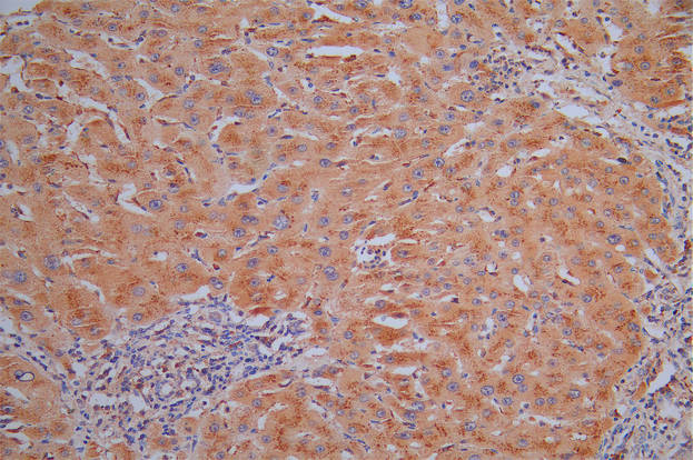 IHC image of RAC07858 diluted at 1:30 and staining in paraffin-embedded human liver cancer performed on a Leica BondTM system. After dewaxing and hydration, antigen retrieval was mediated by high pressure in a citrate buffer (pH 6.0). Section was blocked with 10% normal goat serum 30min at RT. Then primary antibody (1% BSA) was incubated at 4Â°C overnight. The primary is detected by a Goat anti-Mouse IgG labeled by HRP and visualized using 0.05% DAB.