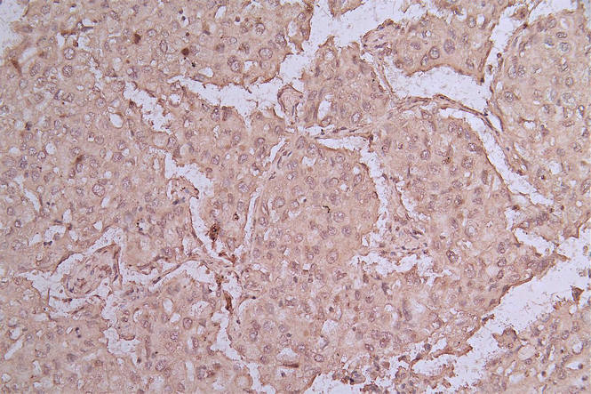 IHC image of RAC07864 diluted at 1:50 and staining in paraffin-embedded human lung cancer performed on a Leica BondTM system. After dewaxing and hydration, antigen retrieval was mediated by high pressure in a citrate buffer (pH 6.0). Section was blocked with 10% normal goat serum 30min at RT. Then primary antibody (1% BSA) was incubated at 4Â°C overnight. The primary is detected by a Goat anti-rabbit polymer IgG labeled by HRP and visualized using 0.05% DAB.