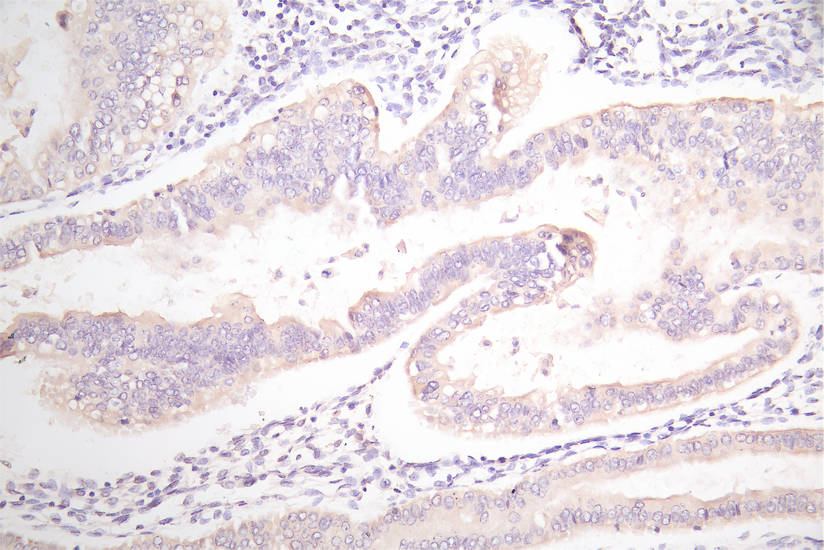 IHC image of RAC07866 diluted at 1:100 and staining in paraffin-embedded human endometrial cancer performed on a Leica BondTM system. After dewaxing and hydration, antigen retrieval was mediated by high pressure in a citrate buffer (pH 6.0). Section was blocked with 10% normal goat serum 30min at RT. Then primary antibody (1% BSA) was incubated at 4Â°C overnight. The primary is detected by a Goat anti-Mouse IgG labeled by HRP and visualized using 0.05% DAB.