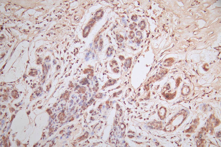 IHC image of RAC07867 diluted at 1:600 and staining in paraffin-embedded human breast cancer performed on a Leica BondTM system. After dewaxing and hydration, antigen retrieval was mediated by high pressure in a citrate buffer (pH 6.0). Section was blocked with 10% normal goat serum 30min at RT. Then primary antibody (1% BSA) was incubated at 4Â°C overnight. The primary is detected by a Goat anti-Mouse IgG labeled by HRP and visualized using 0.05% DAB.