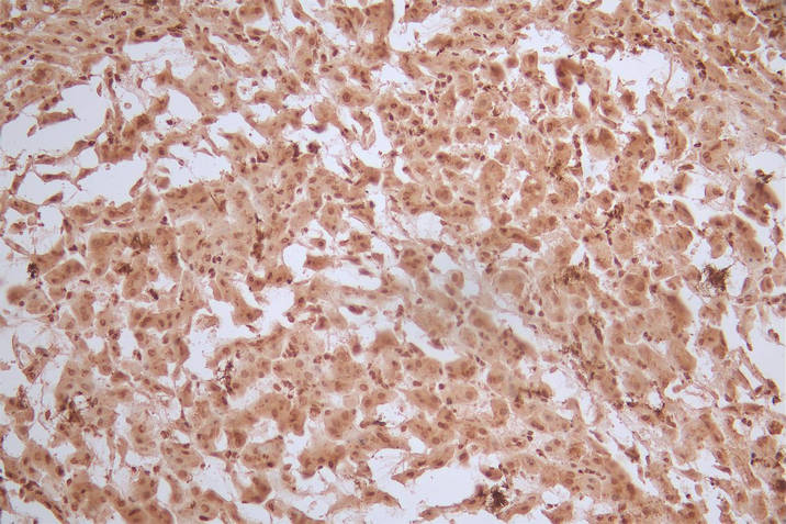 IHC image of RAC07872 diluted at 1:50 and staining in paraffin-embedded human liver tissue performed on a Leica BondTM system. After dewaxing and hydration, antigen retrieval was mediated by high pressure in a citrate buffer (pH 6.0). Section was blocked with 10% normal goat serum 30min at RT. Then primary antibody (1% BSA) was incubated at 4Â°C overnight. The primary is detected by a Goat anti-Mouse IgG labeled by HRP and visualized using 0.05% DAB.