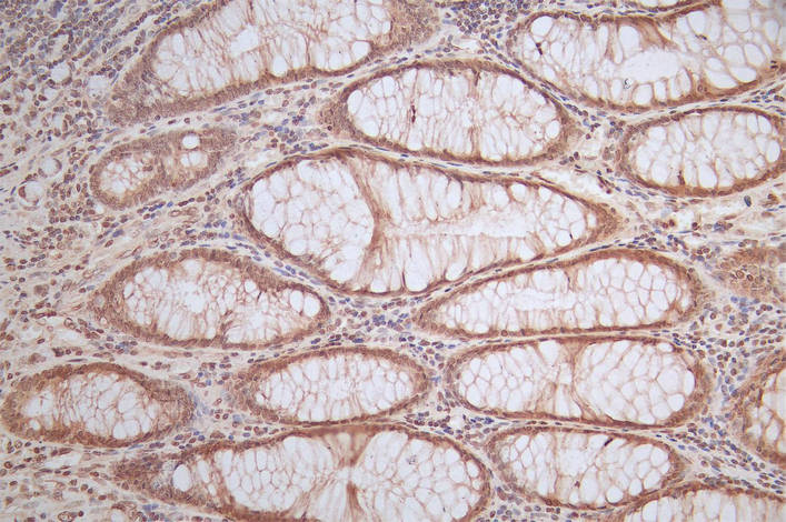IHC image of RAC07872 diluted at 1:50 and staining in paraffin-embedded human rectal cancer performed on a Leica BondTM system. After dewaxing and hydration, antigen retrieval was mediated by high pressure in a citrate buffer (pH 6.0). Section was blocked with 10% normal goat serum 30min at RT. Then primary antibody (1% BSA) was incubated at 4Â°C overnight. The primary is detected by a Goat anti-Mouse IgG labeled by HRP and visualized using 0.05% DAB.