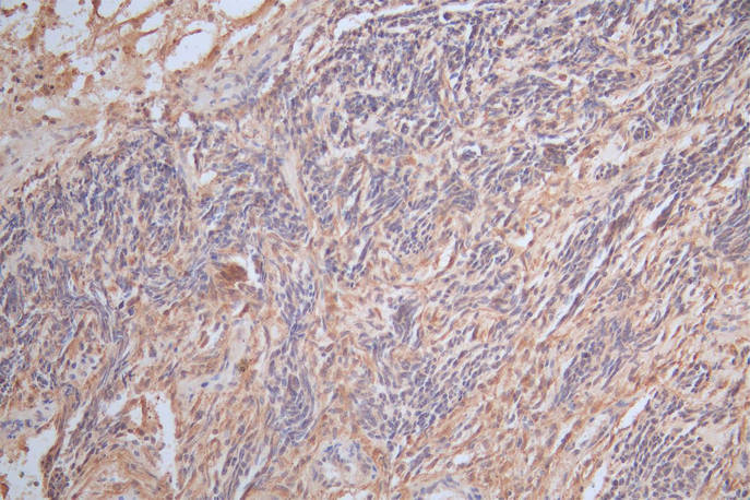 IHC image of RAC07875 diluted at 1:300 and staining in paraffin-embedded human glioma cancer performed on a Leica BondTM system. After dewaxing and hydration, antigen retrieval was mediated by high pressure in a citrate buffer (pH 6.0). Section was blocked with 10% normal goat serum 30min at RT. Then primary antibody (1% BSA) was incubated at 4Â°C overnight. The primary is detected by a Goat anti-Mouse IgG labeled by HRP and visualized using 0.05% DAB.