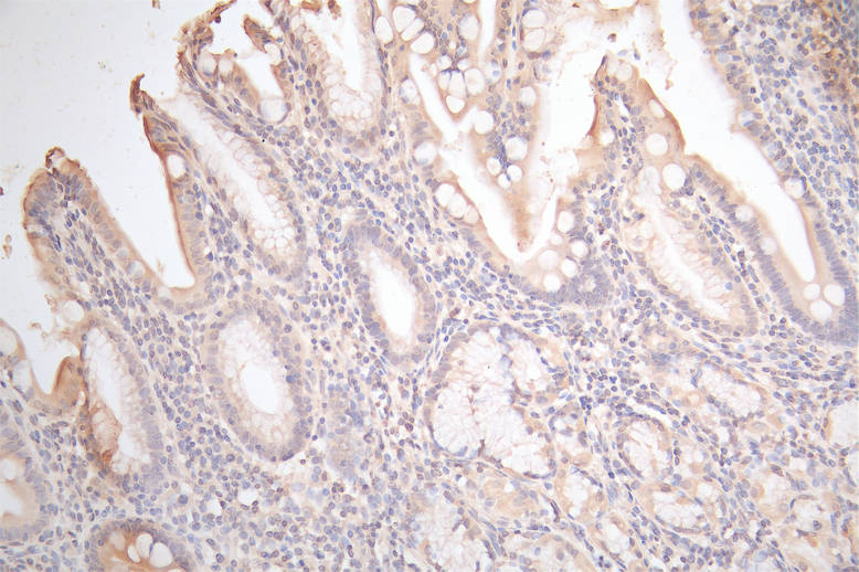 IHC image of RAC07876 diluted at 1:100 and staining in paraffin-embedded human gastric cancer performed on a Leica BondTM system. After dewaxing and hydration, antigen retrieval was mediated by high pressure in a citrate buffer (pH 6.0). Section was blocked with 10% normal goat serum 30min at RT. Then primary antibody (1% BSA) was incubated at 4Â°C overnight. The primary is detected by a Goat anti-Mouse IgG labeled by HRP and visualized using 0.05% DAB.