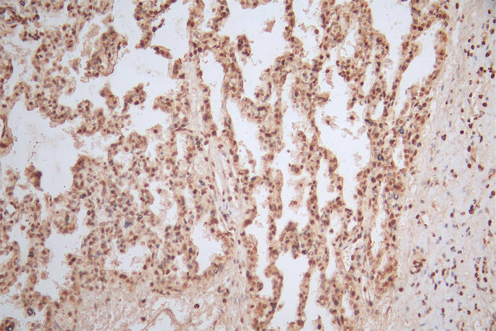 IHC image of RAC07887 diluted at 1:300 and staining in paraffin-embedded human lung tissue performed on a Leica BondTM system. After dewaxing and hydration, antigen retrieval was mediated by high pressure in a citrate buffer (pH 6.0). Section was blocked with 10% normal goat serum 30min at RT. Then primary antibody (1% BSA) was incubated at 4Â°C overnight. The primary is detected by a Goat anti-Mouse IgG labeled by HRP and visualized using 0.05% DAB.