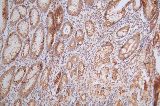 IHC image of RAC07887 diluted at 1:300 and staining in paraffin-embedded human gastric cancer performed on a Leica BondTM system. After dewaxing and hydration, antigen retrieval was mediated by high pressure in a citrate buffer (pH 6.0). Section was blocked with 10% normal goat serum 30min at RT. Then primary antibody (1% BSA) was incubated at 4Â°C overnight. The primary is detected by a Goat anti-Mouse IgG labeled by HRP and visualized using 0.05% DAB.