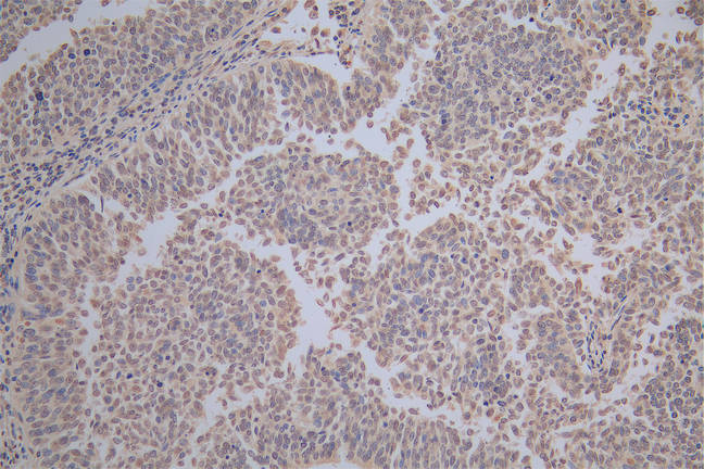 IHC image of RAC07889 diluted at 1:100 and staining in paraffin-embedded human cervical cancer performed on a Leica BondTM system. After dewaxing and hydration, antigen retrieval was mediated by high pressure in a citrate buffer (pH 6.0). Section was blocked with 10% normal goat serum 30min at RT. Then primary antibody (1% BSA) was incubated at 4Â°C overnight. The primary is detected by a Goat anti-Mouse IgG labeled by HRP and visualized using 0.05% DAB.