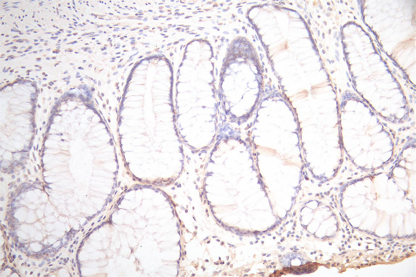 IHC image of RAC07915 diluted at 1:300 and staining in paraffin-embedded human colorectal cancer performed on a Leica BondTM system. After dewaxing and hydration, antigen retrieval was mediated by high pressure in a citrate buffer (pH 6.0). Section was blocked with 10% normal goat serum 30min at RT. Then primary antibody (1% BSA) was incubated at 4Â°C overnight. The primary is detected by a Goat anti-Mouse IgG labeled by HRP and visualized using 0.05% DAB.