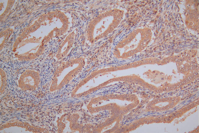 IHC image of RAC07918 diluted at 1:130 and staining in paraffin-embedded human endometrial cancer performed on a Leica BondTM system. After dewaxing and hydration, antigen retrieval was mediated by high pressure in a citrate buffer (pH 6.0). Section was blocked with 10% normal goat serum 30min at RT. Then primary antibody (1% BSA) was incubated at 4Â°C overnight. The primary is detected by a Goat anti-Mouse IgG labeled by HRP and visualized using 0.05% DAB.