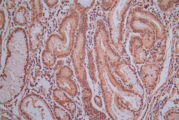 IHC image of RAC07923 diluted at 1:30 and staining in paraffin-embedded human gastric cancer performed on a Leica BondTM system. After dewaxing and hydration, antigen retrieval was mediated by high pressure in a citrate buffer (pH 6.0). Section was blocked with 10% normal goat serum 30min at RT. Then primary antibody (1% BSA) was incubated at 4Â°C overnight. The primary is detected by a Goat anti-Mouse IgG labeled by HRP and visualized using 0.05% DAB.