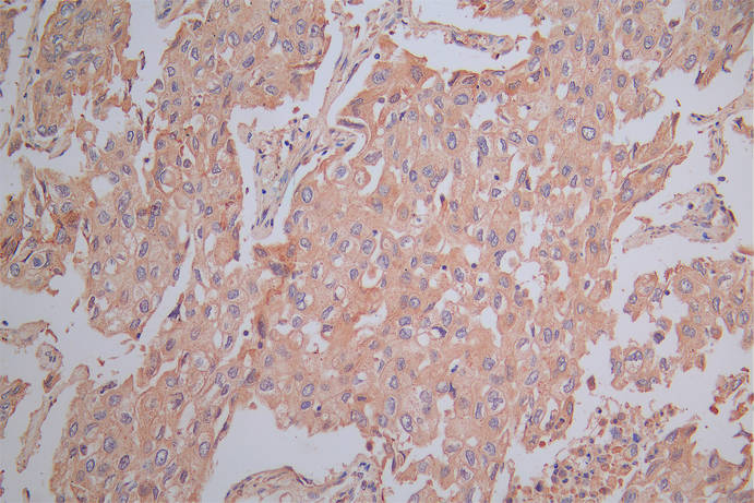 IHC image of RAC07926 diluted at 1:200 and staining in paraffin-embedded human lung cancer performed on a Leica BondTM system. After dewaxing and hydration, antigen retrieval was mediated by high pressure in a citrate buffer (pH 6.0). Section was blocked with 10% normal goat serum 30min at RT. Then primary antibody (1% BSA) was incubated at 4Â°C overnight. The primary is detected by a Goat anti-Mouse IgG labeled by HRP and visualized using 0.05% DAB.