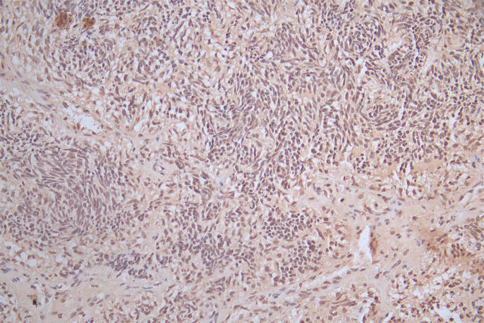IHC image of RAC07929 diluted at 1:100 and staining in paraffin-embedded human glioma cancer performed on a Leica BondTM system. After dewaxing and hydration, antigen retrieval was mediated by high pressure in a citrate buffer (pH 6.0). Section was blocked with 10% normal goat serum 30min at RT. Then primary antibody (1% BSA) was incubated at 4Â°C overnight. The primary is detected by a Goat anti-Mouse IgG labeled by HRP and visualized using 0.05% DAB.