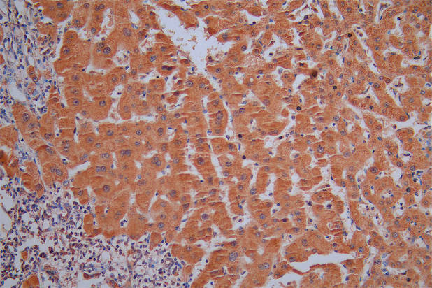 IHC image of RAC07930 diluted at 1:50 and staining in paraffin-embedded human liver cancer performed on a Leica BondTM system. After dewaxing and hydration, antigen retrieval was mediated by high pressure in a citrate buffer (pH 6.0). Section was blocked with 10% normal goat serum 30min at RT. Then primary antibody (1% BSA) was incubated at 4Â°C overnight. The primary is detected by a Goat anti-Mouse IgG labeled by HRP and visualized using 0.05% DAB.