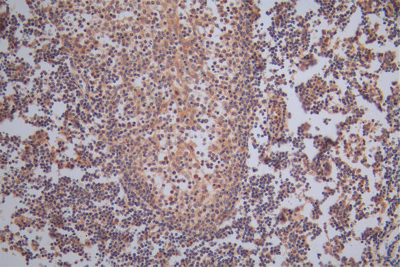 IHC image diluted at 1:50 and staining in paraffin-embedded human tonsil tissue performed on a Leica BondTM system. After dewaxing and hydration, antigen retrieval was mediated by high pressure in a citrate buffer (pH 6.0). Section was blocked with 10% normal goat serum 30min at RT. Then primary antibody (1% BSA) was incubated at 4Â°C overnight. The primary is detected by a Goat anti-Rabbit IgG labeled by HRP and visualized using 0.05% DAB.