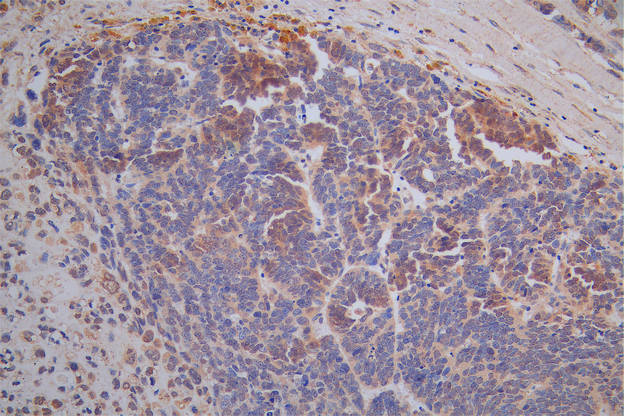 IHC image of RAC07938 diluted at 1:50 and staining in paraffin-embedded human varian cancer performed on a Leica BondTM system. After dewaxing and hydration, antigen retrieval was mediated by high pressure in a citrate buffer (pH 6.0). Section was blocked with 10% normal goat serum 30min at RT. Then primary antibody (1% BSA) was incubated at 4Â°C overnight. The primary is detected by a Goat anti-Rabbit IgG labeled by HRP and visualized using 0.05% DAB.