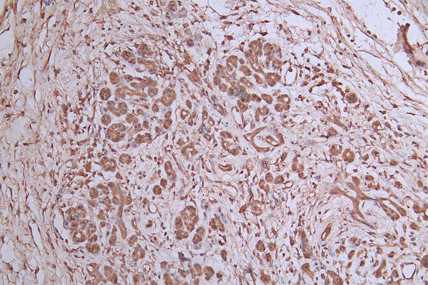 IHC image of RAC07946 diluted at 1:300 and staining in paraffin-embedded human pancreatic cancer performed on a Leica BondTM system. After dewaxing and hydration, antigen retrieval was mediated by high pressure in a citrate buffer (pH 6.0). Section was blocked with 10% normal goat serum 30min at RT. Then primary antibody (1% BSA) was incubated at 4Â°C overnight. The primary is detected by a Goat anti-Mouse IgG labeled by HRP and visualized using 0.05% DAB.