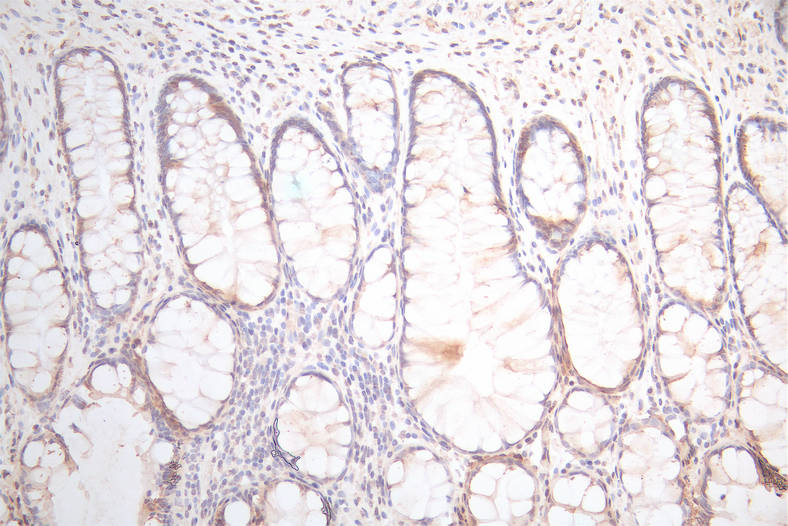 IHC image of RAC07948 diluted at 1:300 and staining in paraffin-embedded human colorectal cancer performed on a Leica BondTM system. After dewaxing and hydration, antigen retrieval was mediated by high pressure in a citrate buffer (pH 6.0). Section was blocked with 10% normal goat serum 30min at RT. Then primary antibody (1% BSA) was incubated at 4Â°C overnight. The primary is detected by a Goat anti-Mouse IgG labeled by HRP and visualized using 0.05% DAB.
