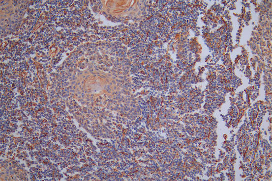 IHC image of RAC07949 diluted at 1:40 and staining in paraffin-embedded human tonsil tissue performed on a Leica BondTM system. After dewaxing and hydration, antigen retrieval was mediated by high pressure in a citrate buffer (pH 6.0). Section was blocked with 10% normal goat serum 30min at RT. Then primary antibody (1% BSA) was incubated at 4Â°C overnight. The primary is detected by a Goat anti-Rabbit IgG labeled by HRP and visualized using 0.05% DAB.