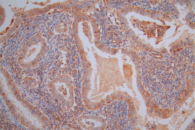 IHC image of RAC07949 diluted at 1:40 and staining in paraffin-embedded human endometrial cancer performed on a Leica BondTM system. After dewaxing and hydration, antigen retrieval was mediated by high pressure in a citrate buffer (pH 6.0). Section was blocked with 10% normal goat serum 30min at RT. Then primary antibody (1% BSA) was incubated at 4Â°C overnight. The primary is detected by a Goat anti-Rabbit IgG labeled by HRP and visualized using 0.05% DAB.