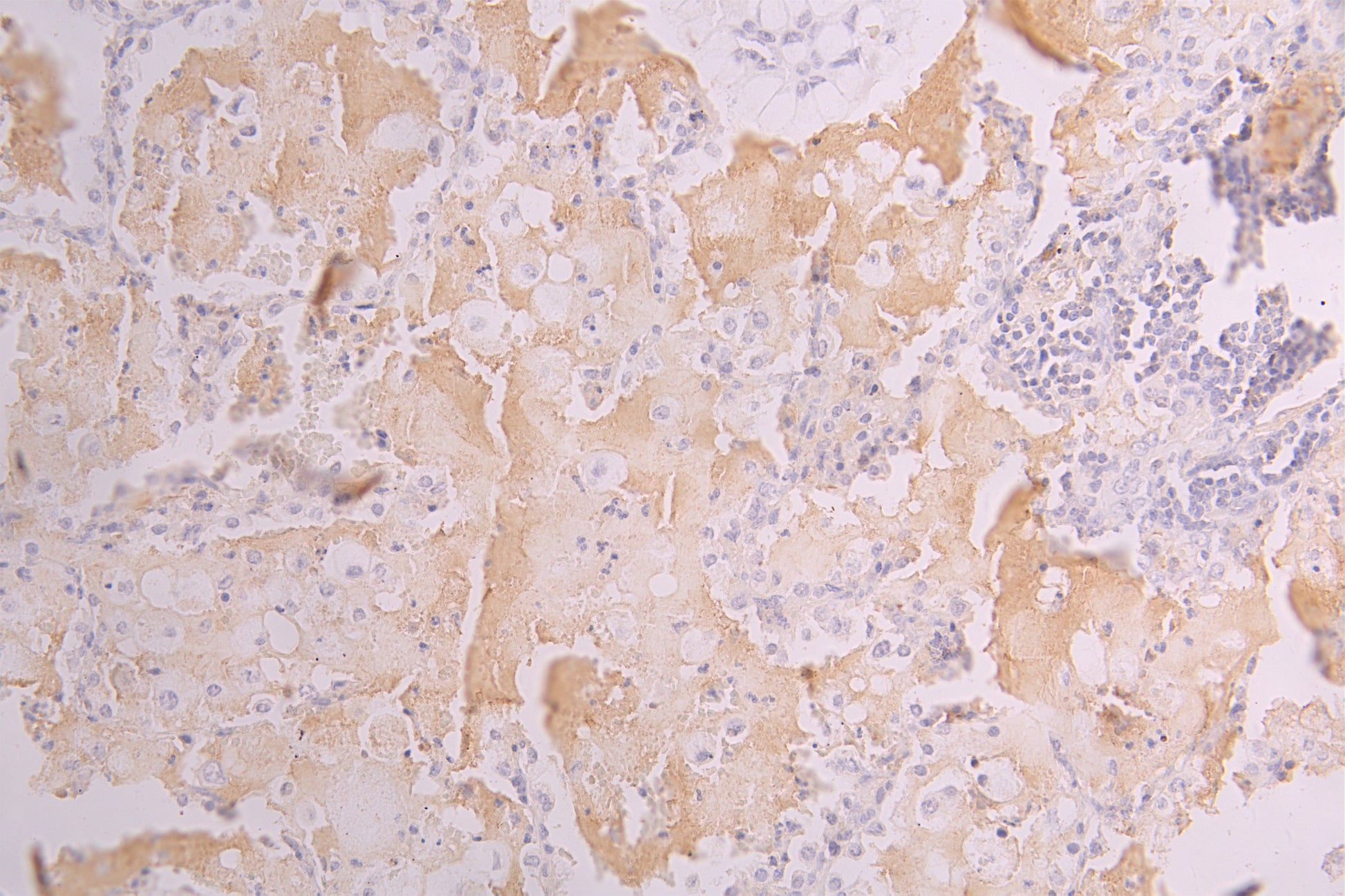 IHC image of RAC07998 diluted at 1ï¼150 and staining in paraffin-embedded human lung tissue performed on a Leica BondTM system. After dewaxing and hydration, antigen retrieval was mediated by high pressure in a citrate buffer (pH 6.0). Section was blocked with 10% normal goat serum 30min at RT. Then primary antibody (1% BSA) was incubated at 4Â°C overnight. The primary is detected by a Goat anti-human polymer IgG labeled by HRP and visualized using 0.05% DAB.