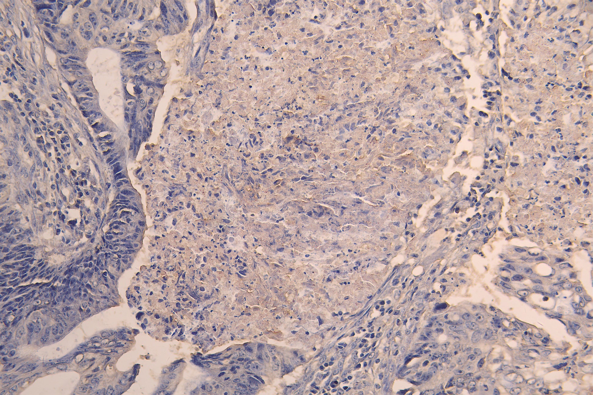 IHC image of RAC08010 diluted at 1:200 and staining in paraffin-embedded human colon cancer performed on a Leica BondTM system. After dewaxing and hydration, antigen retrieval was mediated by high pressure in a citrate buffer (pH 6.0). Section was blocked with 10% normal goat serum 30min at RT. Then primary antibody (1% BSA) was incubated at 4Â°C overnight. The primary is detected by a Goat anti-human polymer IgG labeled by HRP and visualized using 0.05% DAB.