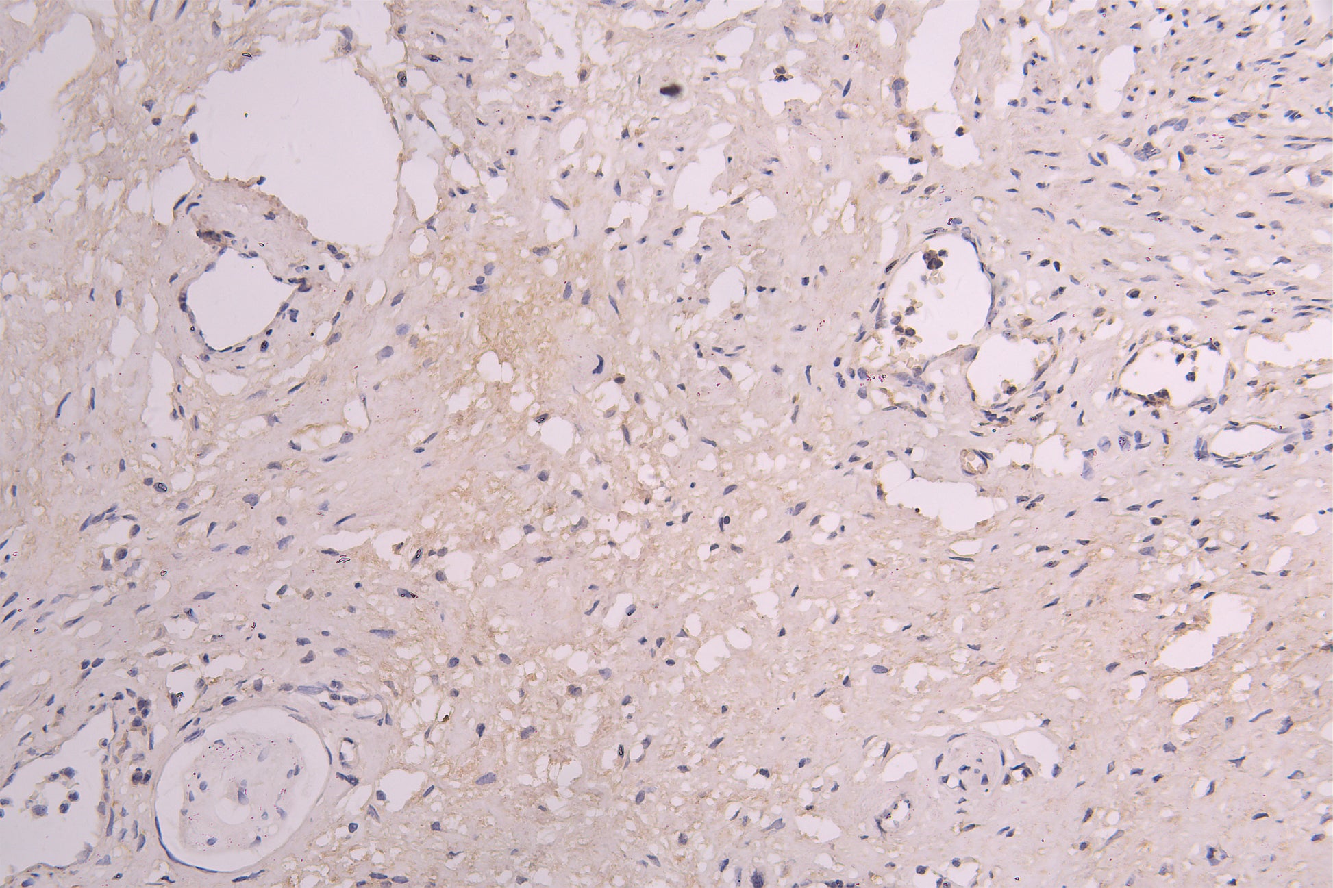 IHC image of RAC08011 diluted at 1ï¼100 and staining in paraffin-embedded human cervical cancer performed on a Leica BondTM system. After dewaxing and hydration, antigen retrieval was mediated by high pressure in a citrate buffer (pH 6.0). Section was blocked with 10% normal goat serum 30min at RT. Then primary antibody (1% BSA) was incubated at 4Â°C overnight. The primary is detected by a Goat anti-human polymer IgG labeled by HRP and visualized using 0.05% DAB.