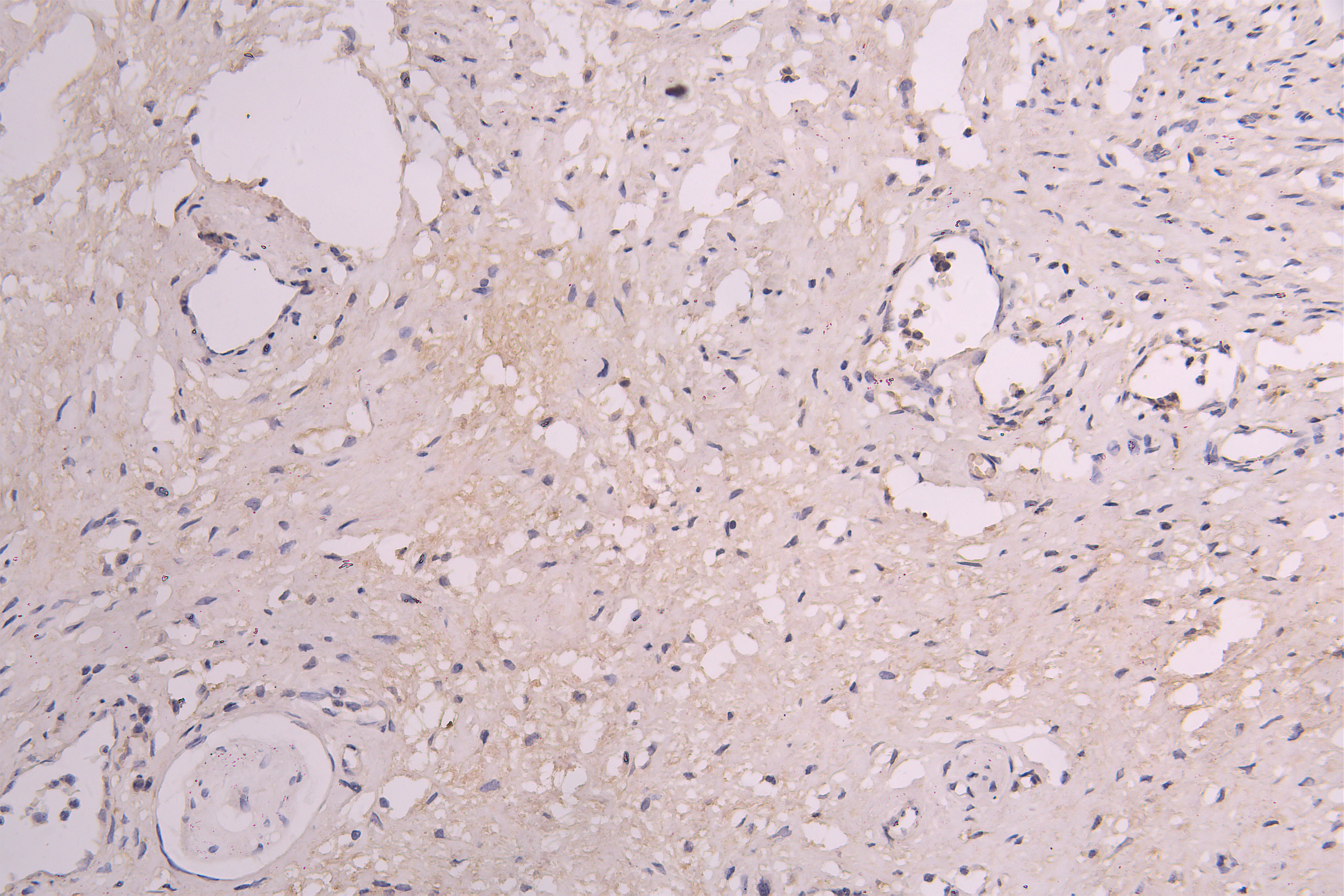 IHC image of RAC08011 diluted at 1ï¼100 and staining in paraffin-embedded human cervical cancer performed on a Leica BondTM system. After dewaxing and hydration, antigen retrieval was mediated by high pressure in a citrate buffer (pH 6.0). Section was blocked with 10% normal goat serum 30min at RT. Then primary antibody (1% BSA) was incubated at 4Â°C overnight. The primary is detected by a Goat anti-human polymer IgG labeled by HRP and visualized using 0.05% DAB.