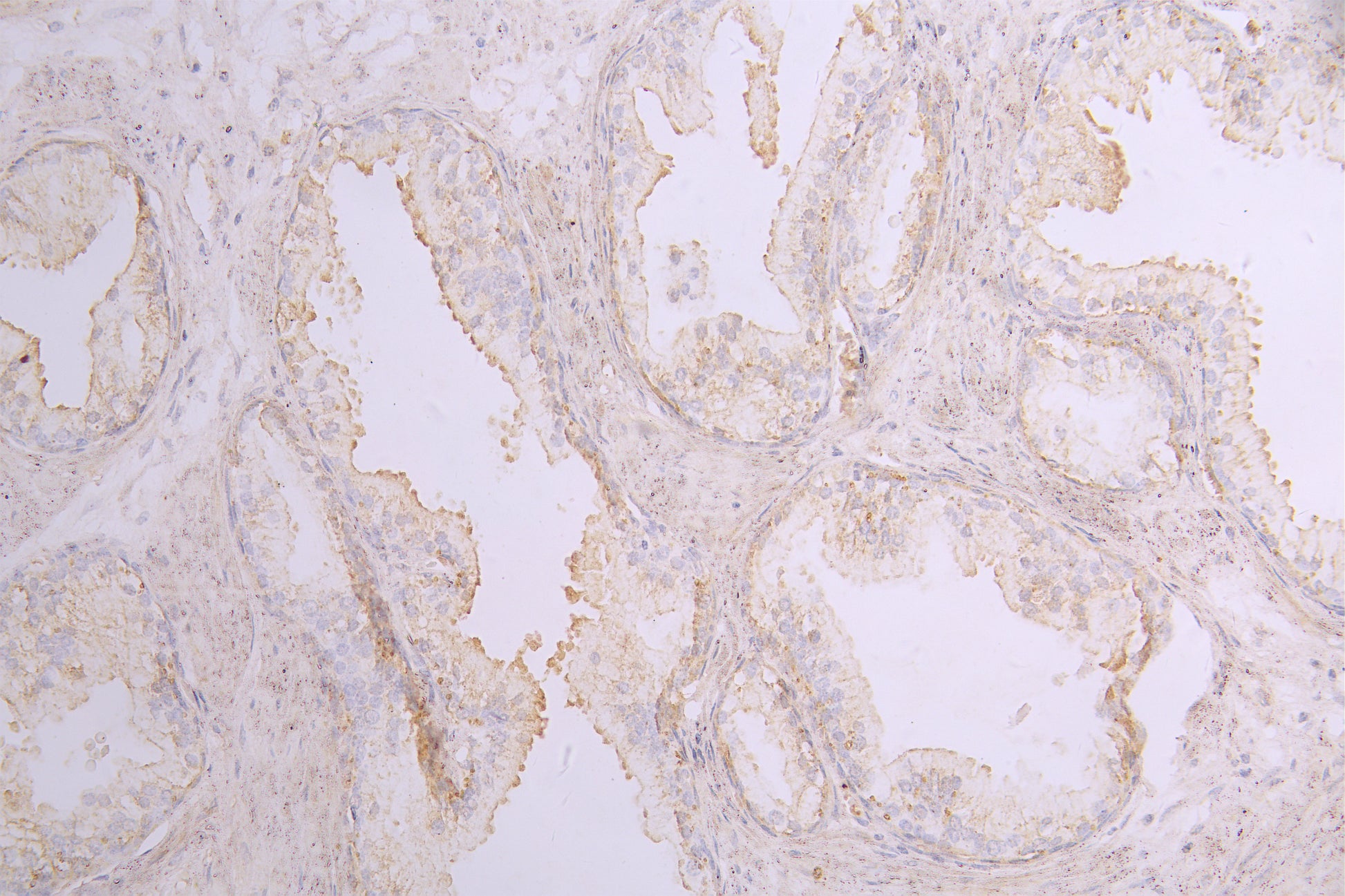 IHC image of RAC08013 diluted at 1ï¼100 and staining in paraffin-embedded human prostate cancer performed on a Leica BondTM system. After dewaxing and hydration, antigen retrieval was mediated by high pressure in a citrate buffer (pH 6.0). Section was blocked with 10% normal goat serum 30min at RT. Then primary antibody (1% BSA) was incubated at 4Â°C overnight. The primary is detected by a Goat anti-human polymer IgG labeled by HRP and visualized using 0.05% DAB.