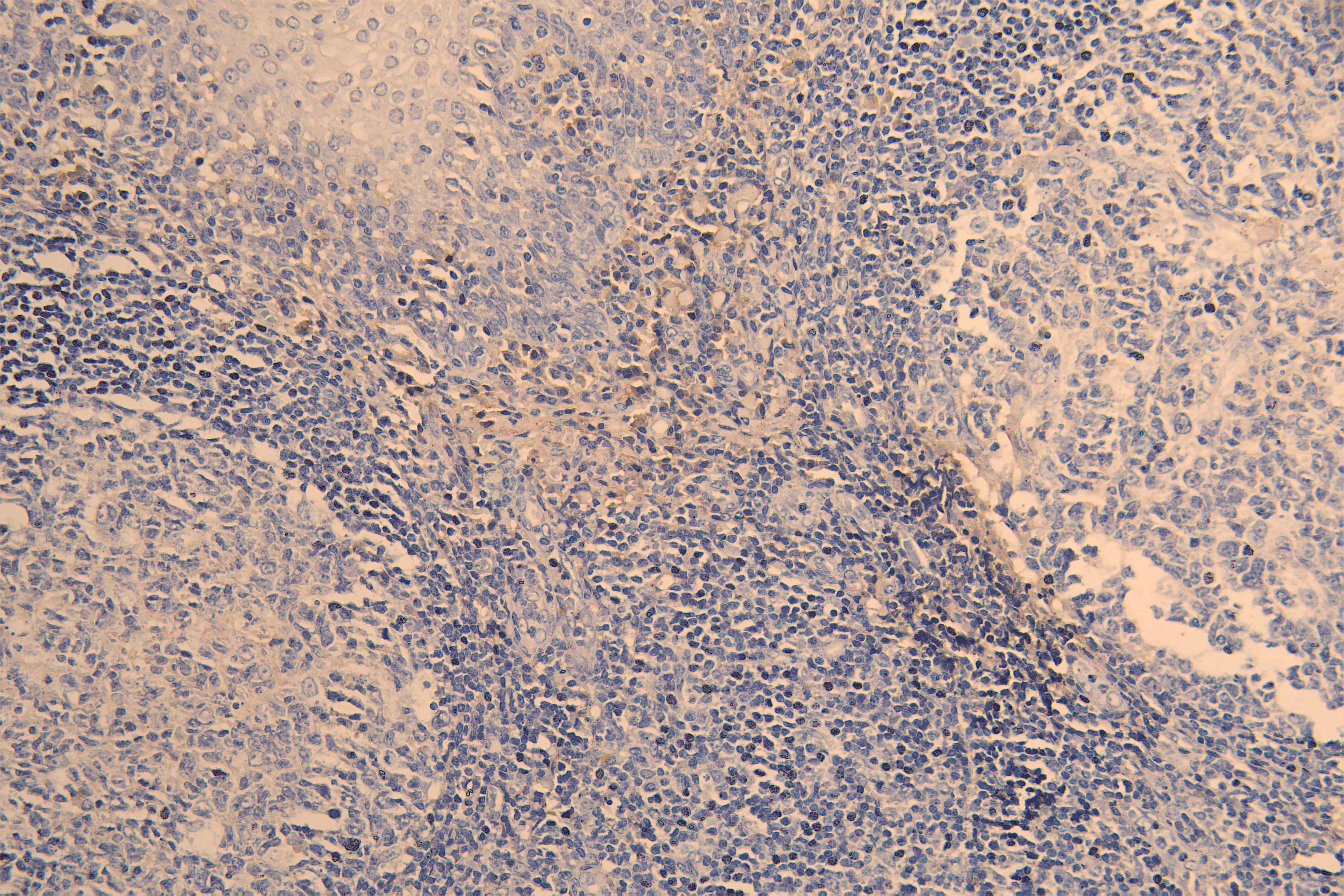 IHC image of RAC08015 diluted at 1:200 and staining in paraffin-embedded human tonsil tissue performed on a Leica BondTM system. After dewaxing and hydration, antigen retrieval was mediated by high pressure in a citrate buffer (pH 6.0). Section was blocked with 10% normal goat serum 30min at RT. Then primary antibody (1% BSA) was incubated at 4Â°C overnight. The primary is detected by a Goat anti-human polymer IgG labeled by HRP and visualized using 0.05% DAB.