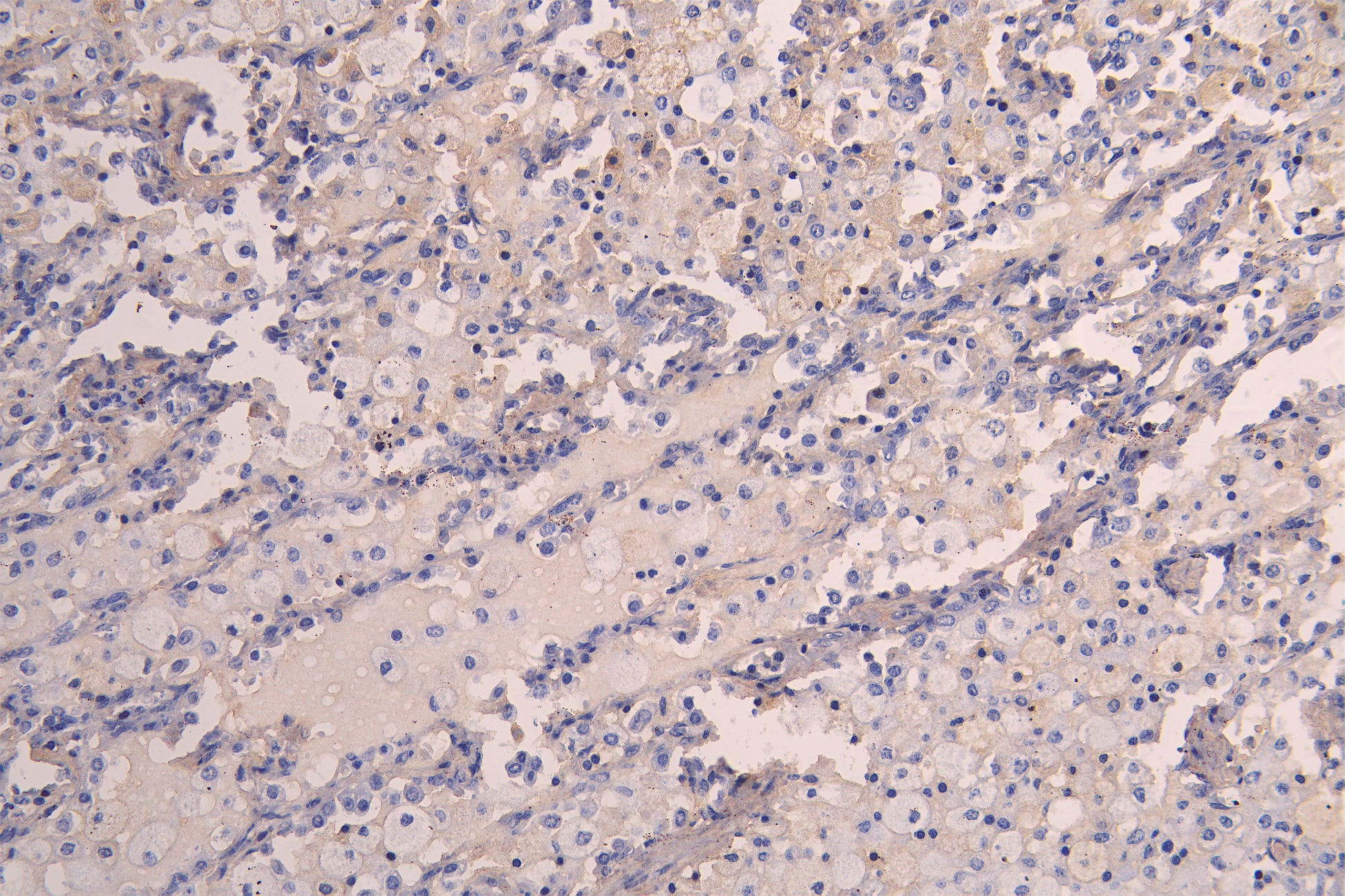 IHC image of RAC08019 diluted at 1:200 and staining in paraffin-embedded human lung tissue performed on a Leica BondTM system. After dewaxing and hydration, antigen retrieval was mediated by high pressure in a citrate buffer (pH 6.0). Section was blocked with 10% normal goat serum 30min at RT. Then primary antibody (1% BSA) was incubated at 4Â°C overnight. The primary is detected by a Goat anti-human polymer IgG labeled by HRP and visualized using 0.05% DAB.