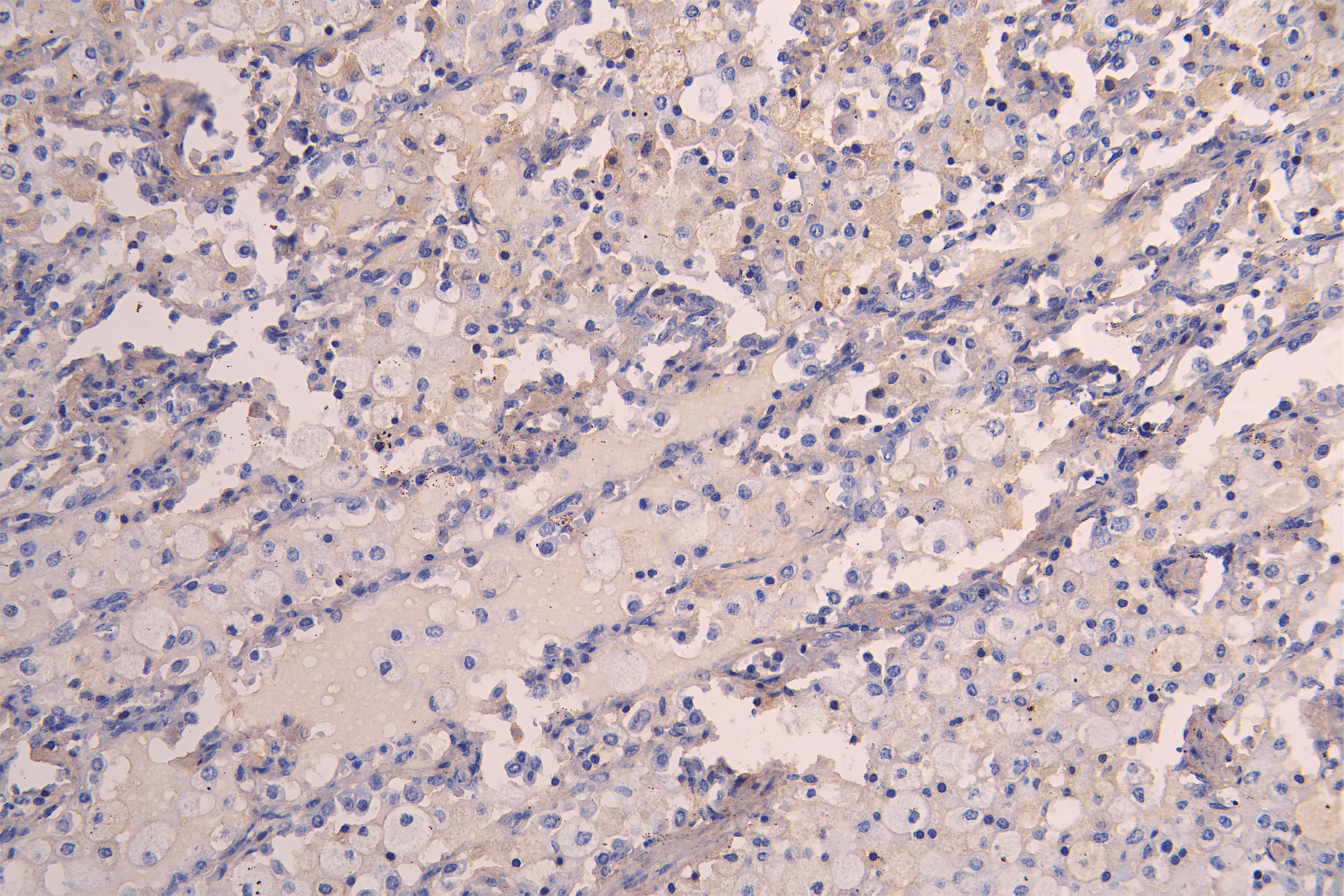 IHC image of RAC08019 diluted at 1:200 and staining in paraffin-embedded human lung tissue performed on a Leica BondTM system. After dewaxing and hydration, antigen retrieval was mediated by high pressure in a citrate buffer (pH 6.0). Section was blocked with 10% normal goat serum 30min at RT. Then primary antibody (1% BSA) was incubated at 4Â°C overnight. The primary is detected by a Goat anti-human polymer IgG labeled by HRP and visualized using 0.05% DAB.
