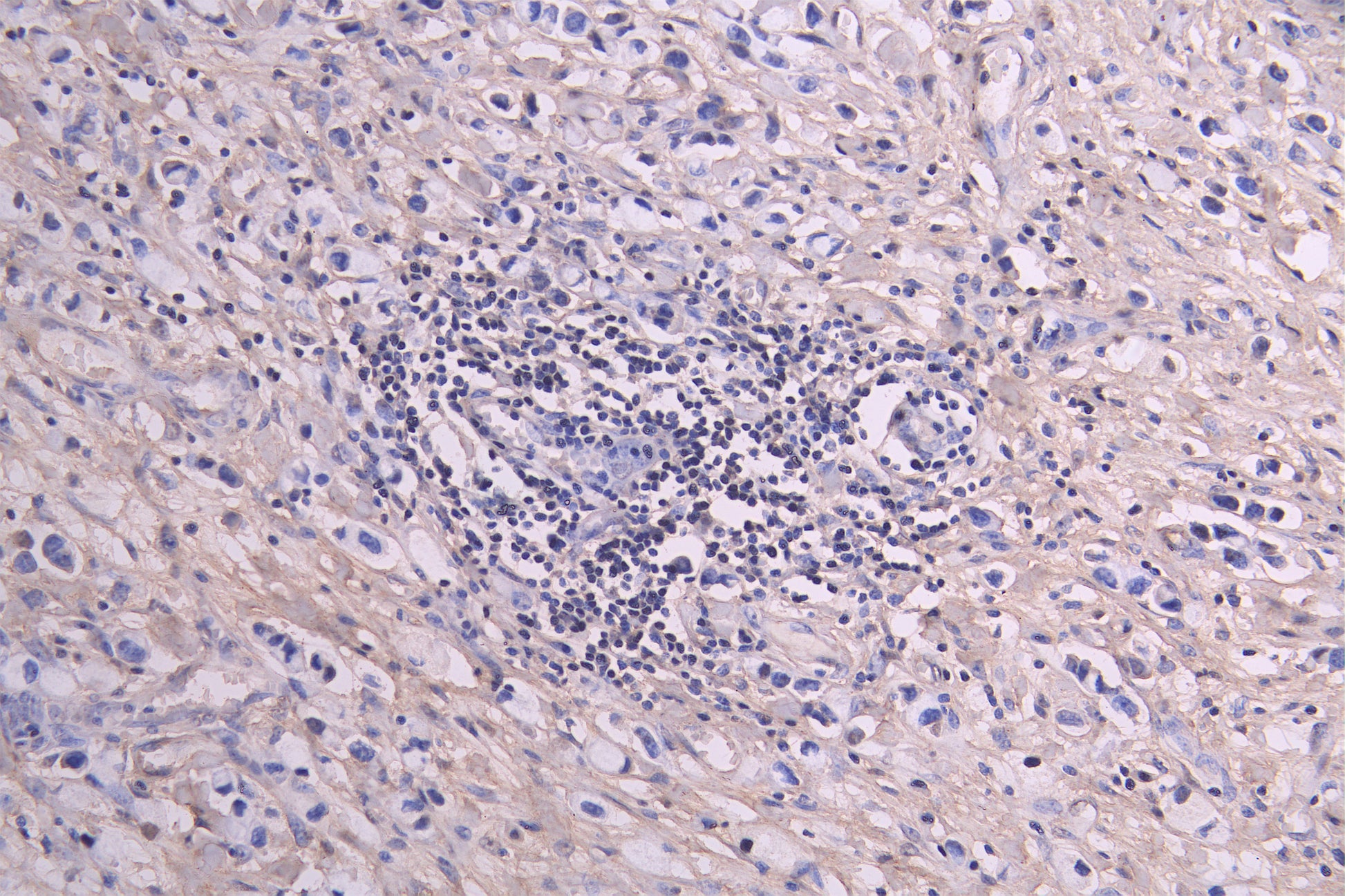 IHC image of RAC08020 diluted at 1ï¼100 and staining in paraffin-embedded human gastric cancer performed on a Leica BondTM system. After dewaxing and hydration, antigen retrieval was mediated by high pressure in a citrate buffer (pH 6.0). Section was blocked with 10% normal goat serum 30min at RT. Then primary antibody (1% BSA) was incubated at 4Â°C overnight. The primary is detected by a Goat anti-human polymer IgG labeled by HRP and visualized using 0.05% DAB.