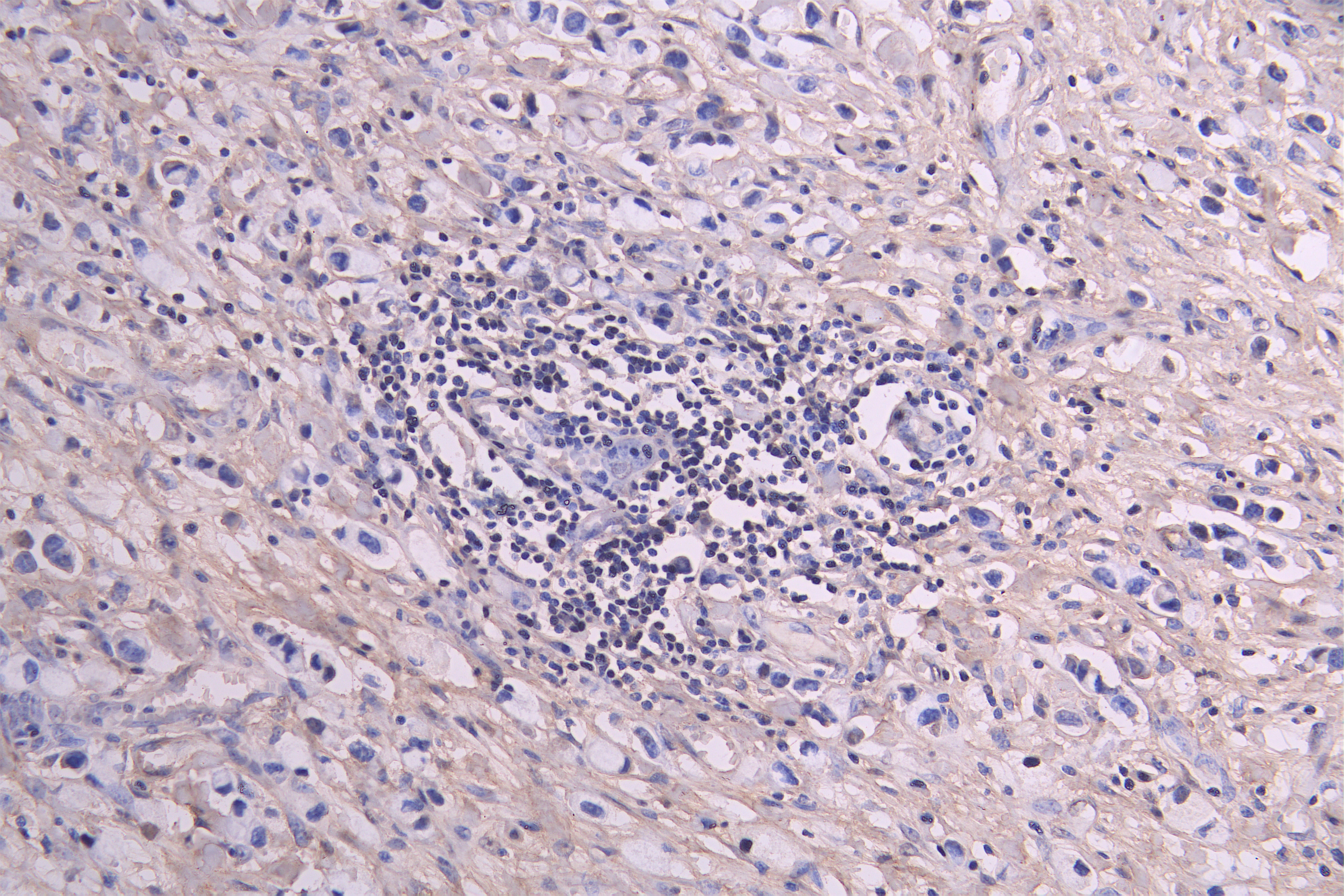 IHC image of RAC08020 diluted at 1ï¼100 and staining in paraffin-embedded human gastric cancer performed on a Leica BondTM system. After dewaxing and hydration, antigen retrieval was mediated by high pressure in a citrate buffer (pH 6.0). Section was blocked with 10% normal goat serum 30min at RT. Then primary antibody (1% BSA) was incubated at 4Â°C overnight. The primary is detected by a Goat anti-human polymer IgG labeled by HRP and visualized using 0.05% DAB.