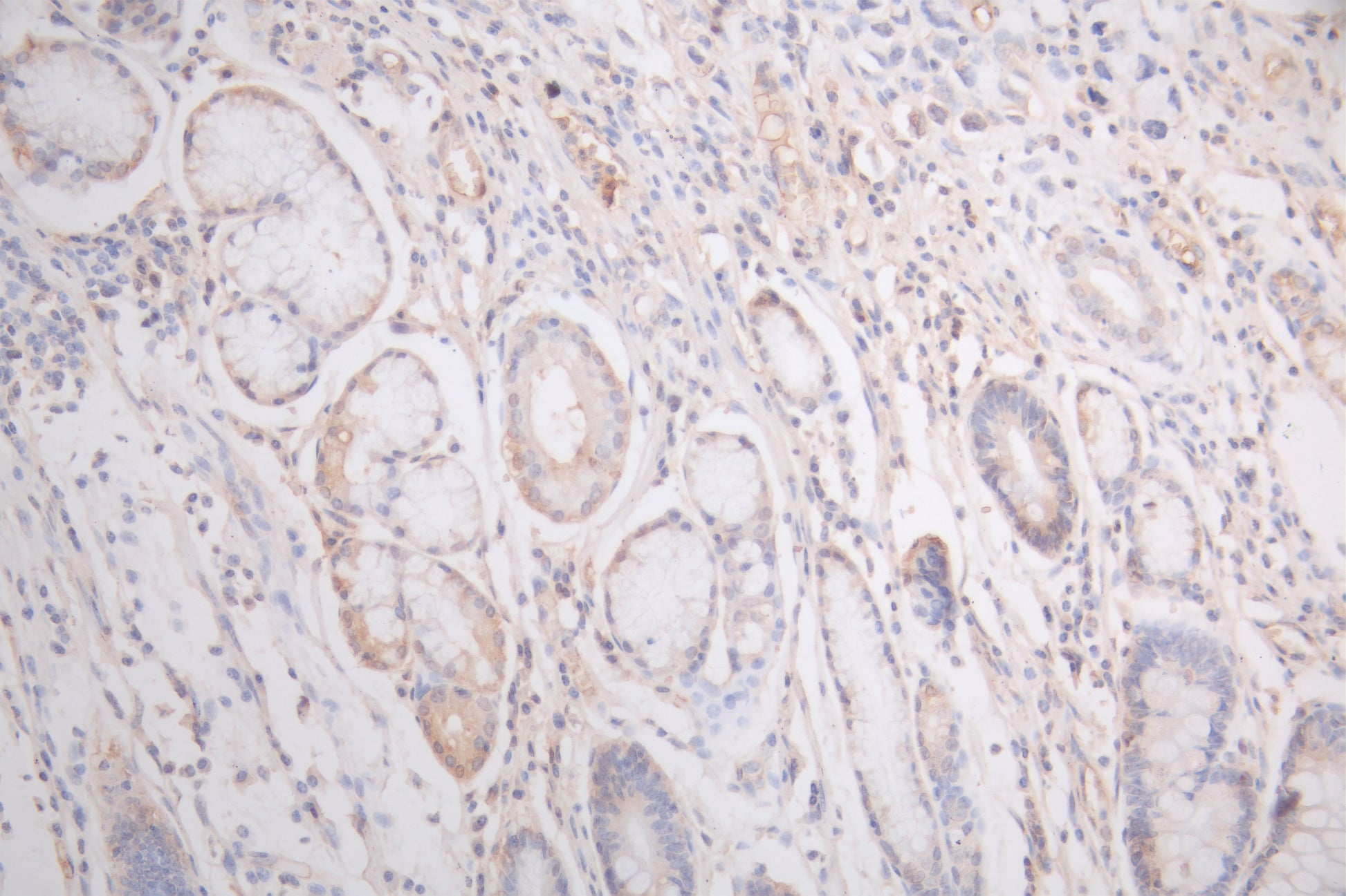 IHC image of RAC08024 diluted at 1:200 and staining in paraffin-embedded human gastric cancer performed on a Leica BondTM system. After dewaxing and hydration, antigen retrieval was mediated by high pressure in a citrate buffer (pH 6.0). Section was blocked with 10% normal goat serum 30min at RT. Then primary antibody (1% BSA) was incubated at 4Â°C overnight. The primary is detected by a Goat anti-human polymer IgG labeled by HRP and visualized using 0.05% DAB.
