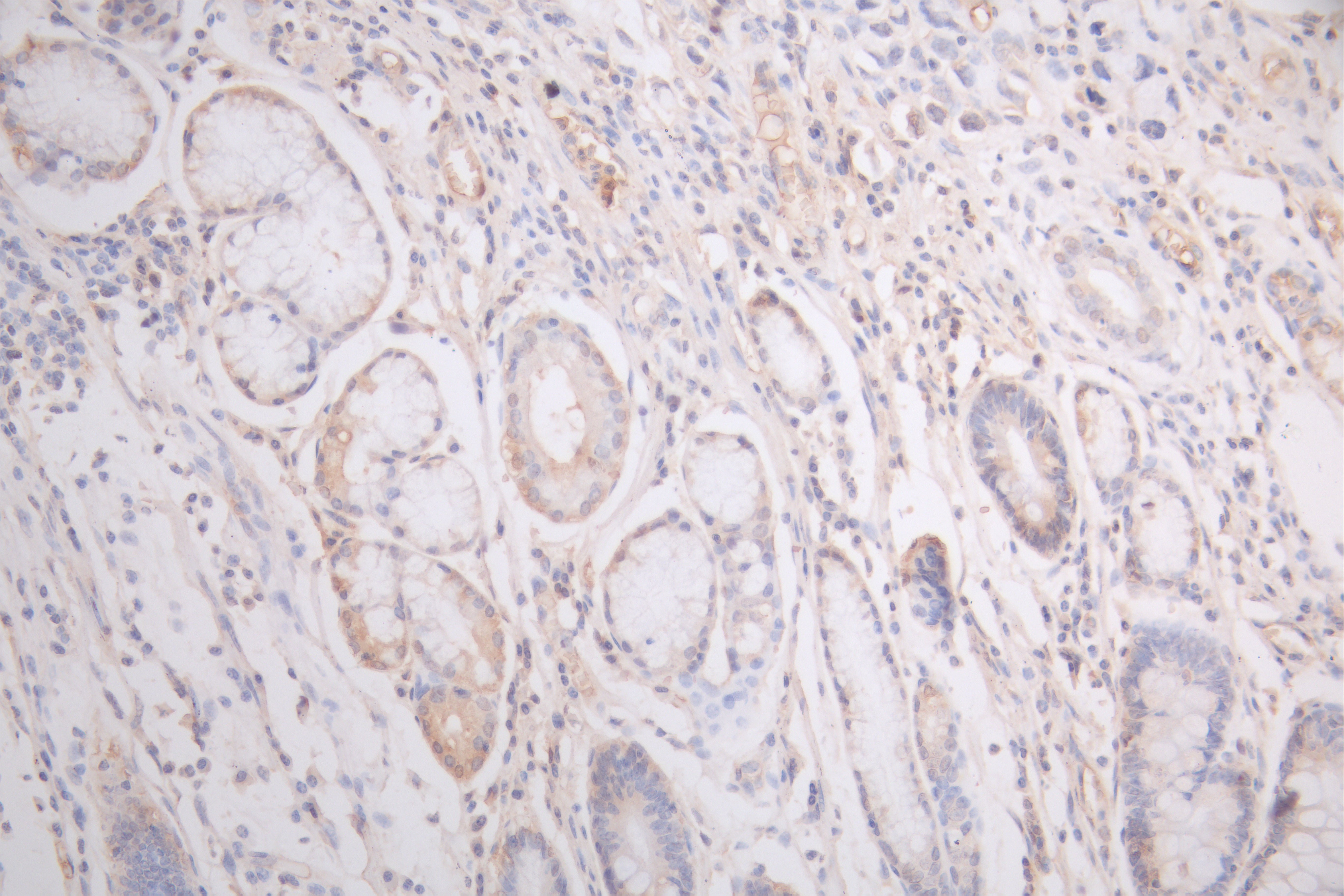 IHC image of RAC08024 diluted at 1:200 and staining in paraffin-embedded human gastric cancer performed on a Leica BondTM system. After dewaxing and hydration, antigen retrieval was mediated by high pressure in a citrate buffer (pH 6.0). Section was blocked with 10% normal goat serum 30min at RT. Then primary antibody (1% BSA) was incubated at 4Â°C overnight. The primary is detected by a Goat anti-human polymer IgG labeled by HRP and visualized using 0.05% DAB.