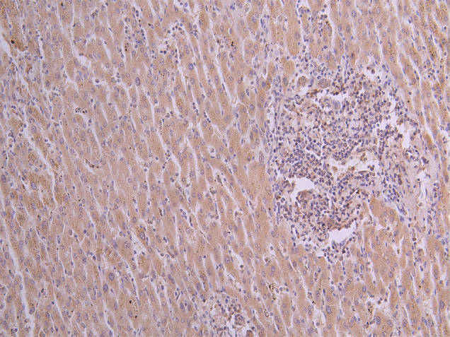 IHC image of diluted at 1:50 and staining in paraffin-embedded human liver cancer performed on a Leica BondTM system. After dewaxing and hydration, antigen retrieval was mediated by high pressure in a citrate buffer (pH 6.0). Section was blocked with 10% normal goat serum 30min at RT. Then primary antibody (1% BSA) was incubated at 4Â°C overnight. The primary is detected by a Goat anti-human polymer IgG labeled by HRP and visualized using 0.05% DAB.